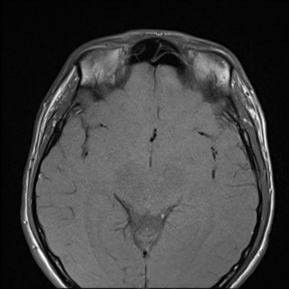 Nasopharyngeal carcinoma with skull base invasion (Radiopaedia 53415-59485 Axial T1 11).jpg