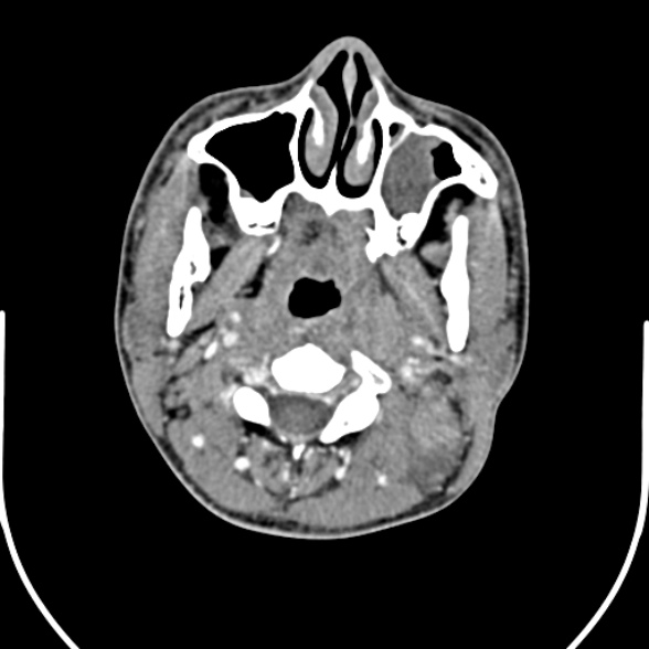 Nasopharyngeal carcinoma with skull base invasion (Radiopaedia 53415-59705 A 71).jpg