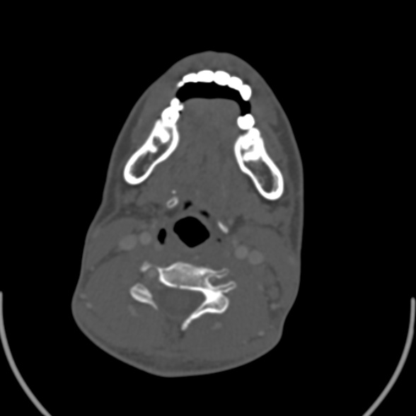 Nasopharyngeal carcinoma with skull base invasion (Radiopaedia 53415-59705 Axial bone window 124).jpg