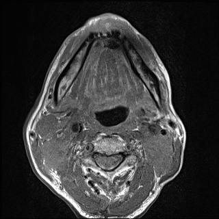 Nasopharyngeal carcinoma with skull base invasion (Radiopaedia 59258-66600 B 39).jpg