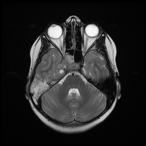 File:Nasopharyngeal rhabdomyosarcoma (Radiopaedia 23417-23486 Axial T2 7).jpg