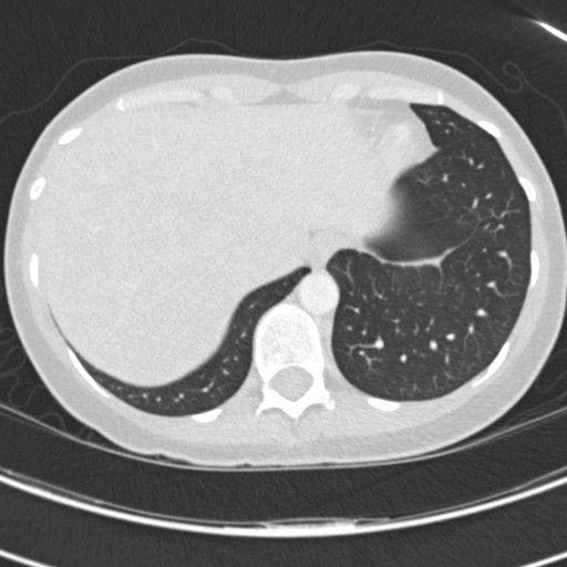 Necrobiotic pulmonary nodules - Crohn disease (Radiopaedia 20723-20631 Axial lung window 121).jpg