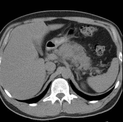 File:Necrotizing pancreatitis with acute necrotic collection (Radiopaedia 14470-14417 Axial non-contrast 8).jpg