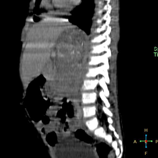 File:Neuroblastoma (Radiopaedia 24751-25016 C 16).jpg