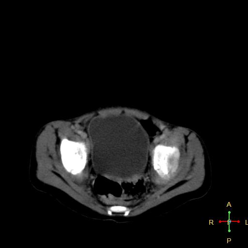 File:Neuroblastoma (Radiopaedia 24751-25016 D 39).jpg