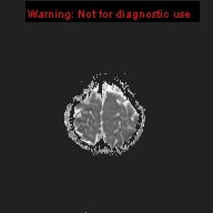 File:Neurofibromatosis type 1 with optic nerve glioma (Radiopaedia 16288-15965 Axial ADC 2).jpg