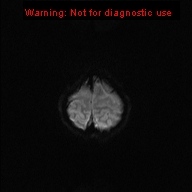 File:Neurofibromatosis type 1 with optic nerve glioma (Radiopaedia 16288-15965 Axial DWI 26).jpg
