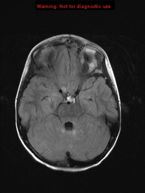 File:Neurofibromatosis type 1 with optic nerve glioma (Radiopaedia 16288-15965 Axial FLAIR 17).jpg