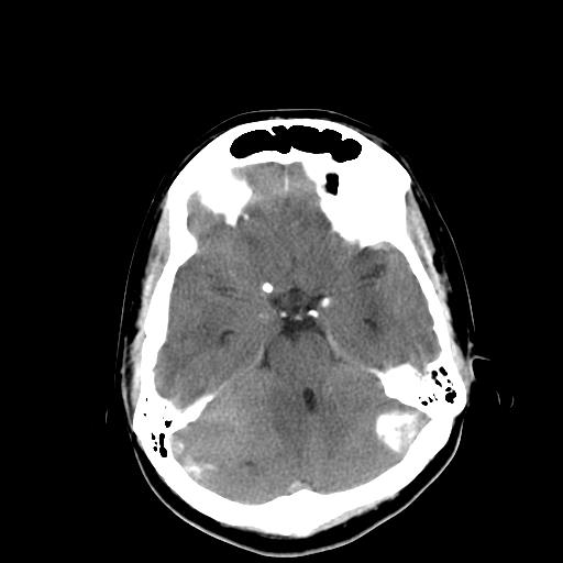 File:Neurofibromatosis type 2 (Radiopaedia 25389-25637 Axial non-contrast 8).jpg