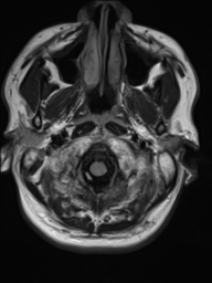 File:Neurofibromatosis type 2 (Radiopaedia 44936-48838 Axial FLAIR 1).png