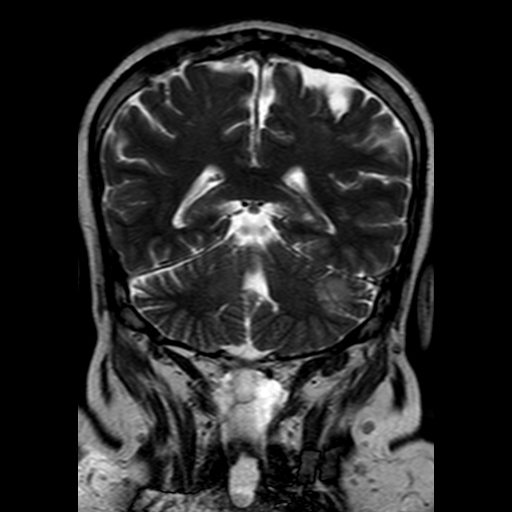 File:Neurofibromatosis type 2 (Radiopaedia 8713-9518 Coronal T2 17).jpg