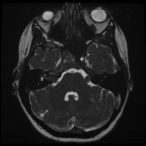 Neurofibromatosis type 2 - bilateral acoustic neuromata (Radiopaedia 40060-42566 Axial FIESTA 42).png