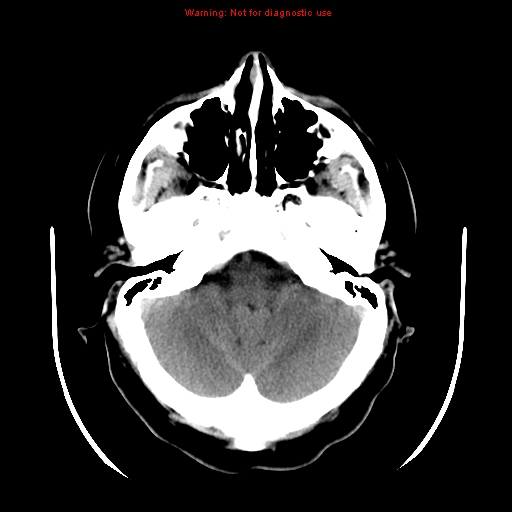 File:Neuroglial cyst (Radiopaedia 10713-11185 Axial non-contrast 26).jpg