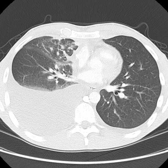 File:Non-Hodgkin lymphoma involving lung (Radiopaedia 29094-29470 Axial lung window 40).jpg