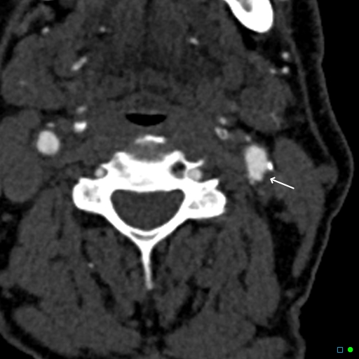 File:Non-occlusive intraluminal internal carotid artery thrombus (Radiopaedia 37751-39658 D 1).jpg