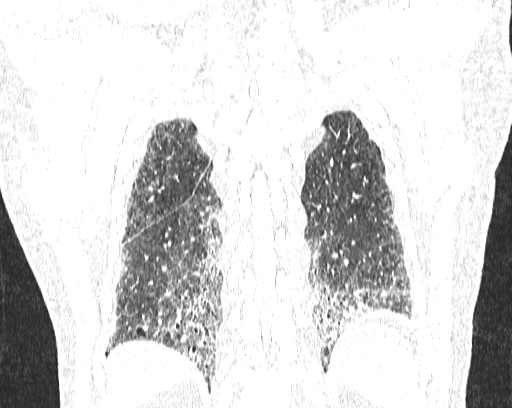 Non-specific interstitial pneumonia (NSIP) (Radiopaedia 68599-78228 Coronal lung window 87).jpg