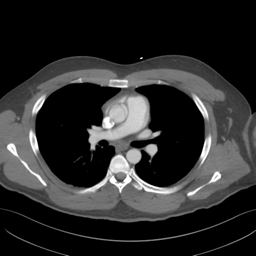 File:Normal CTA thorax (non ECG gated) (Radiopaedia 41750-44704 A 45).png