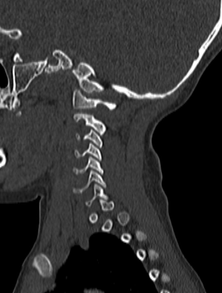 File:Normal CT cervical spine - pediatric (Radiopaedia 52549-58462 Sagittal bone window 173).jpg