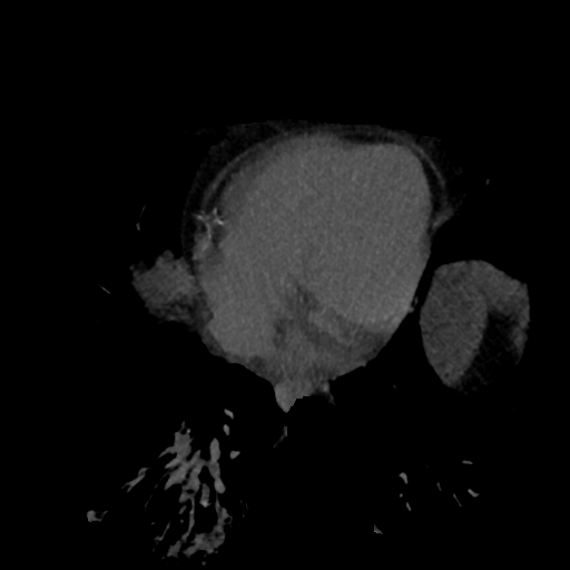 File:Normal CT intravenous cholangiogram (Radiopaedia 38199-40208 Axial IVC (MIP) 95).png