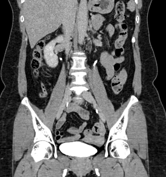 Normal CT intravenous urogram (Radiopaedia 39444-41759 A 273).jpg