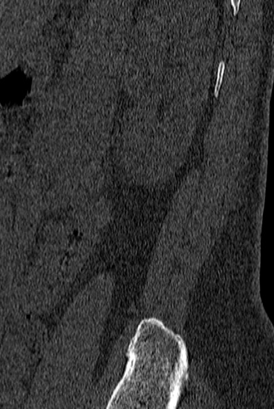 File:Normal CT lumbar spine (Radiopaedia 53981-60118 Sagittal bone window 95).jpg
