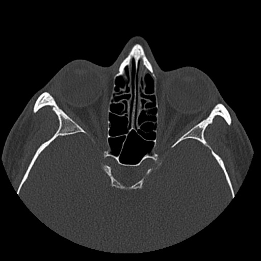 Normal CT paranasal sinuses (Radiopaedia 42286-45390 Axial bone window 46).jpg