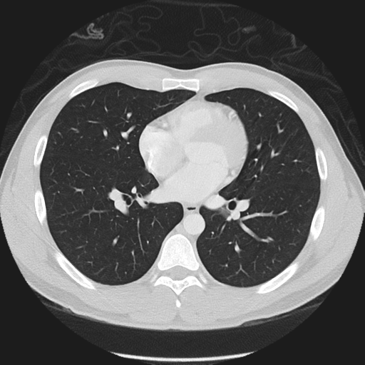 Normal CT pulmonary veins (pre RF ablation) (Radiopaedia 41748-44702 Axial lung window 30).png