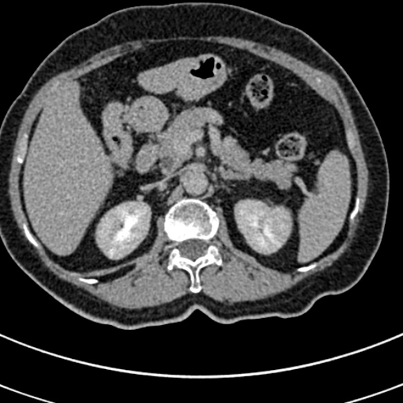 File:Normal CT split bolus study of the renal tract (Radiopaedia 48631-53634 Axial split bolus 43).jpg