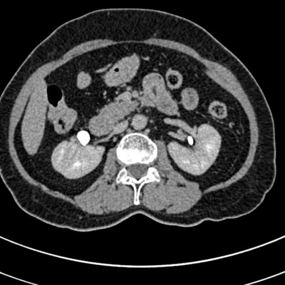 File:Normal CT split bolus study of the renal tract (Radiopaedia 48631-53634 Axial split bolus 79).jpg