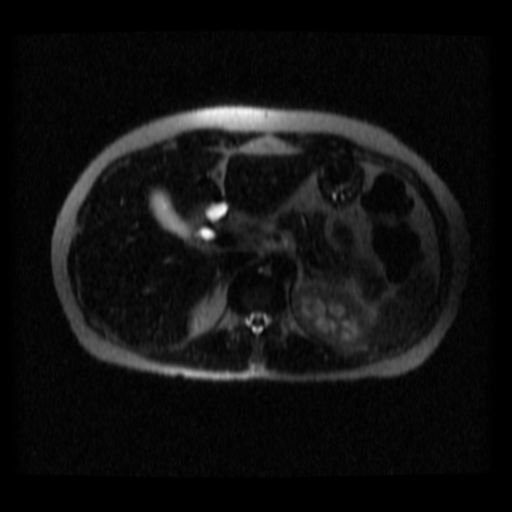 File:Normal MRCP (Radiopaedia 41966-44978 Axial T2 thins 22).png
