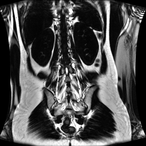 Normal MRI abdomen in pregnancy (Radiopaedia 88001-104541 N 106).jpg