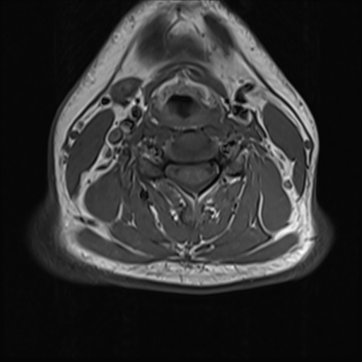 File:Normal MRI cervical spine (infection protocol) (Radiopaedia 53916-60039 Axial 27).png