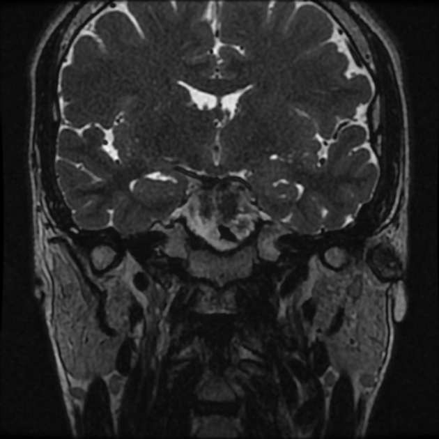 Normal MRI petrous (Radiopaedia 91317-108949 Coronal T2 25).jpg