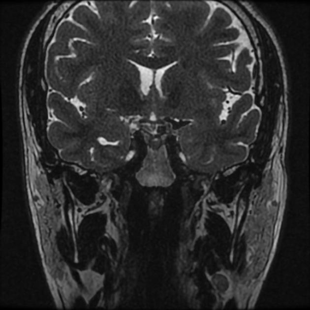 Normal MRI petrous (Radiopaedia 91317-108949 Coronal T2 6).jpg