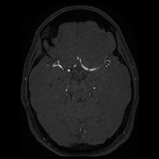 Normal brain MRA (Radiopaedia 41046-43793 Axial MRA 51).png
