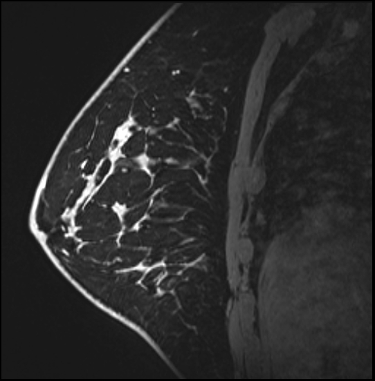 Normal breast MRI - dense breasts (Radiopaedia 80454-93850 I 125).jpg