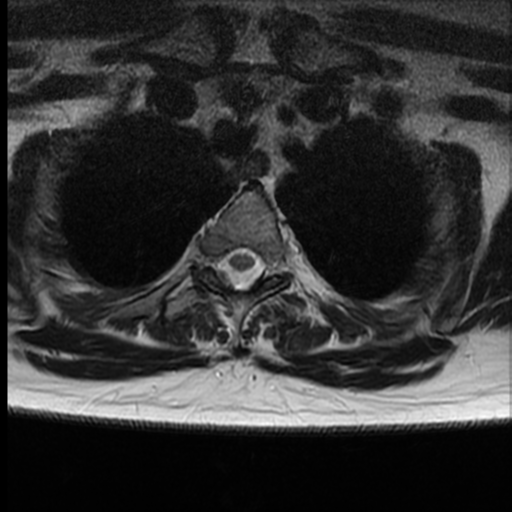 File:Normal cervical and thoracic spine MRI (Radiopaedia 35630-37156 H 36).png