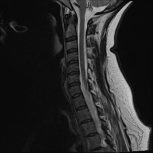 File:Normal cervical spine MRI (including Dixon) (Radiopaedia 42762-45925 Dixon- in-phase 7).png