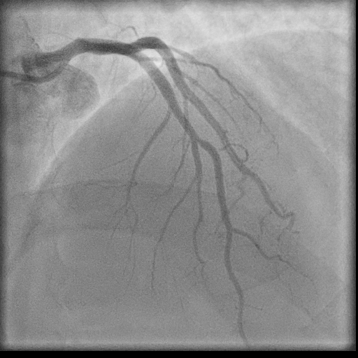 Normal coronary angiogram (DSA) (Radiopaedia 63081-71571 E 31).jpg