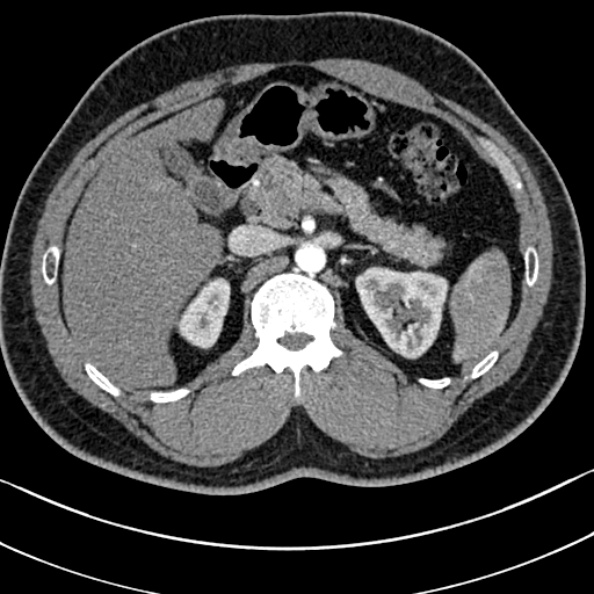 Normal kidneys on 4-phase CT study (Radiopaedia 25889-26038 B 18).jpg