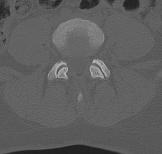 File:Normal lumbar spine CT (Radiopaedia 46533-50986 Axial bone window 53).png