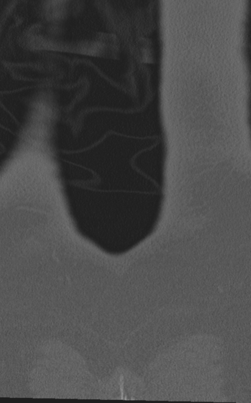Normal lumbar spine CT (Radiopaedia 46533-50986 Coronal bone window 88).png