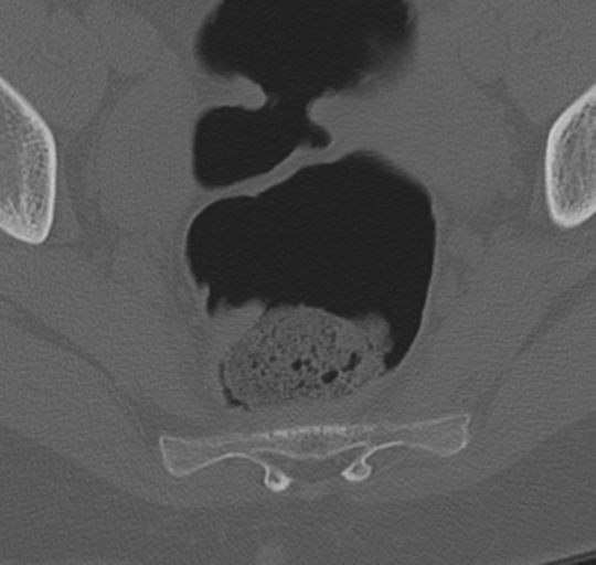 File:Normal lumbosacral CT (Radiopaedia 37923-39867 Axial bone window 102).png