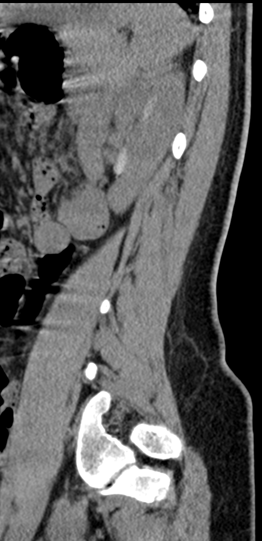 Normal lumbosacral CT (Radiopaedia 37923-39867 E 27).png
