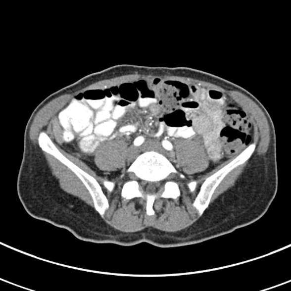 File:Normal multiphase CT liver (Radiopaedia 38026-39996 B 60).jpg
