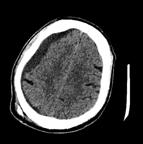 Normal pressure hydrocephalus (Radiopaedia 73685-84479 Axial non-contrast 59).jpg