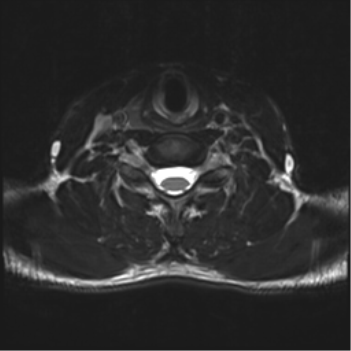 Normal trauma cervical spine (Radiopaedia 41017-43762 D 39).png