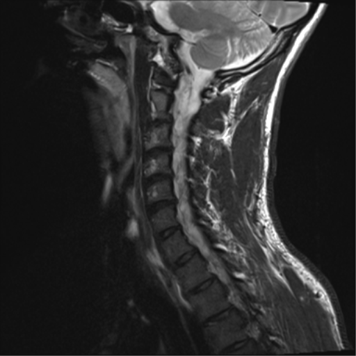 File:Normal trauma cervical spine (Radiopaedia 41017-43762 Sagittal T2 11).png