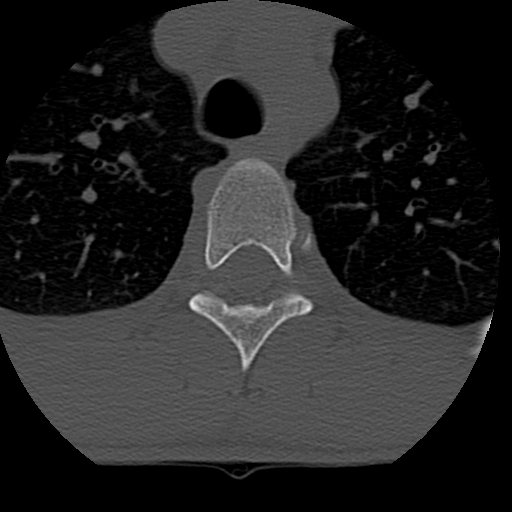 File:Normal trauma spine imaging (age 16) (Radiopaedia 45335-49358 Axial bone window 101).jpg