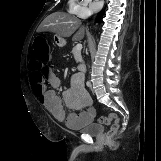 Obstructive colonic diverticular stricture (Radiopaedia 81085-94675 C 121).jpg